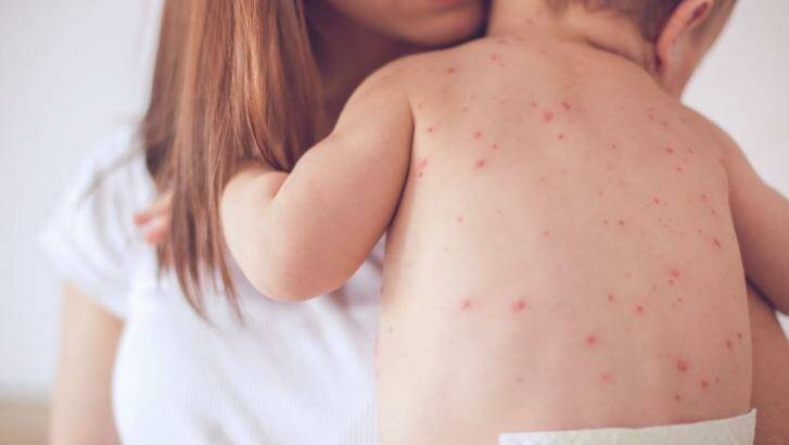 Two more cases of measles have been confirmed. 